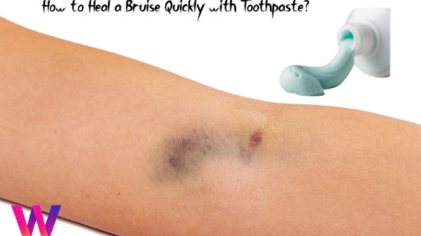 how to heal a bruise