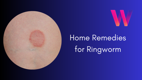 Home Remedies for Ringworm