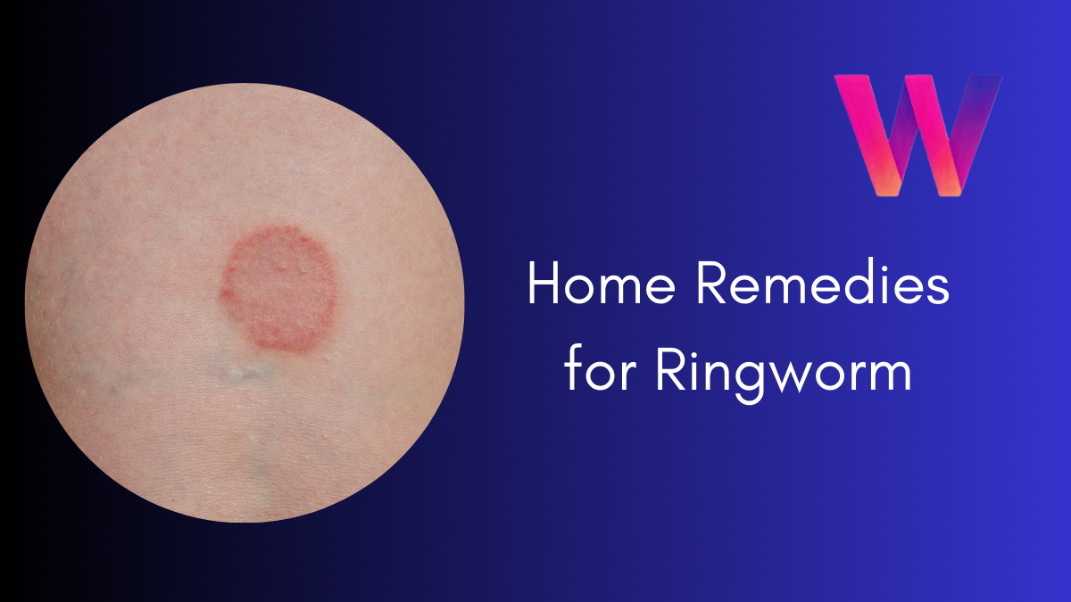 Home Remedies for Ringworm