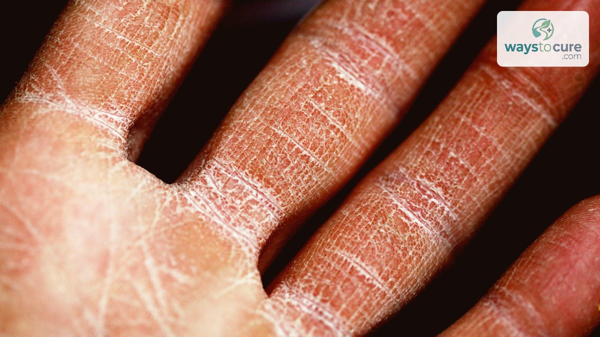 Close-up of a palm with very dry, cracked, peeling skin